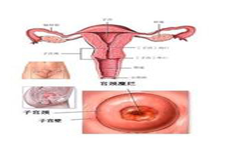 阴道炎会导致宫颈糜烂发生