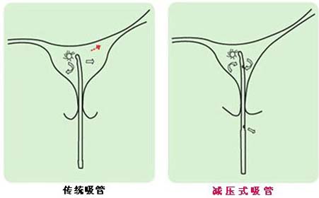 无痛人流的概述