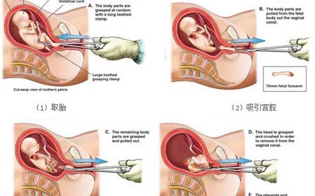 无痛人流是怎么做的