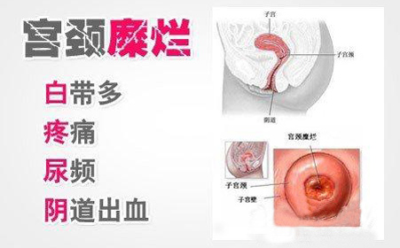 宫颈糜烂的症状有哪些？